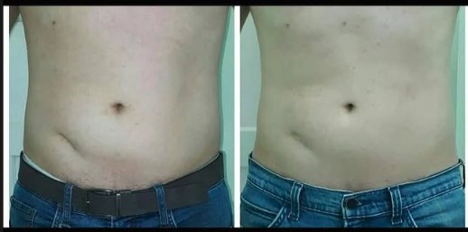 Antes e depois de cavitação no abdome