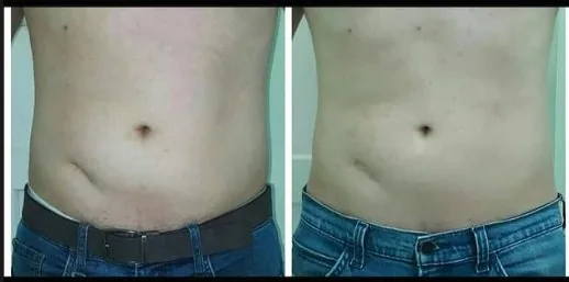 Antes e depois de cavitação no abdome