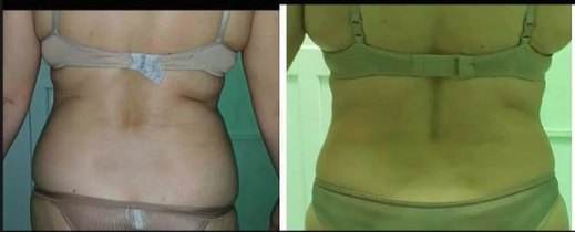Antes e depois de cavitação nos flancos