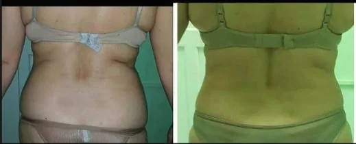 Antes e depois de cavitação nos flancos