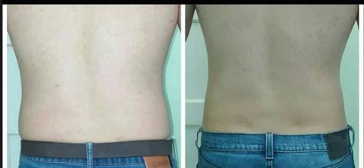 Antes e depois de cavitação na lombar