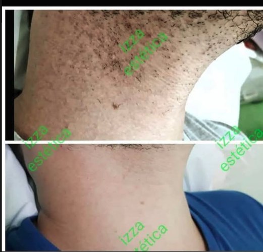 Antes e depois de depilação a laser masculina na axila