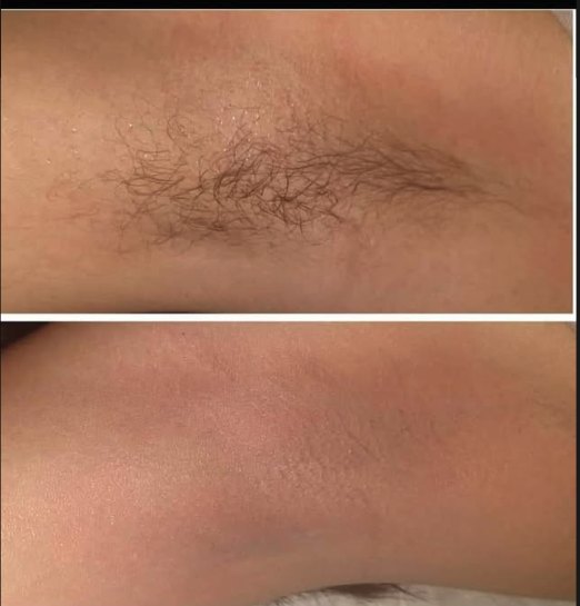 Antes e depois de depilação a laser na axila