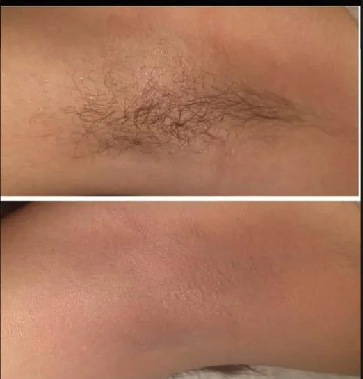 Antes e depois de depilação a laser na axila