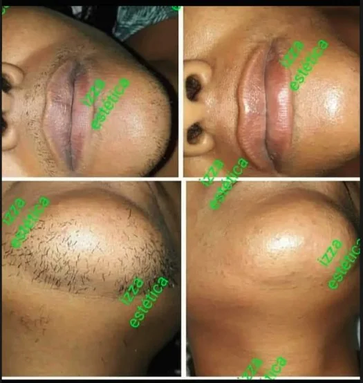 Antes e depois de depilação a laser no buço e ombro