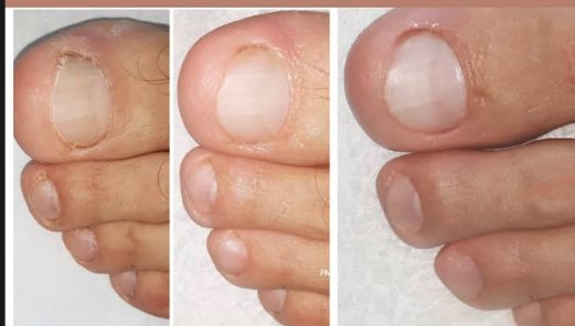 Evolução do tratamento de micose de unha a laser