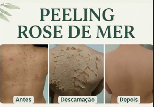 Peeling Rose de Mer: antes, descamação e depois