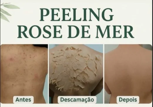 Peeling Rose de Mer: antes, descamação e depois