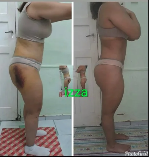 Evolução de paciente em drenagem pós-cirúrgica